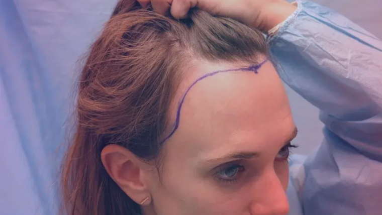 Female Hair Transplant