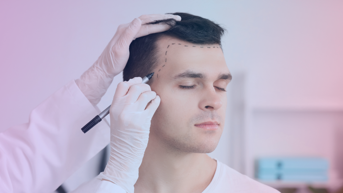 Male Hair Transplant