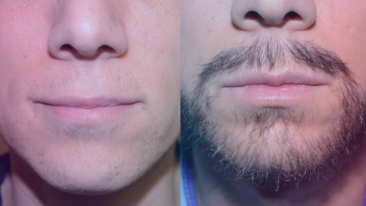 Moustache Hair Transplant