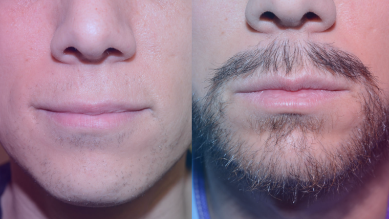 Beard Hair Transplant