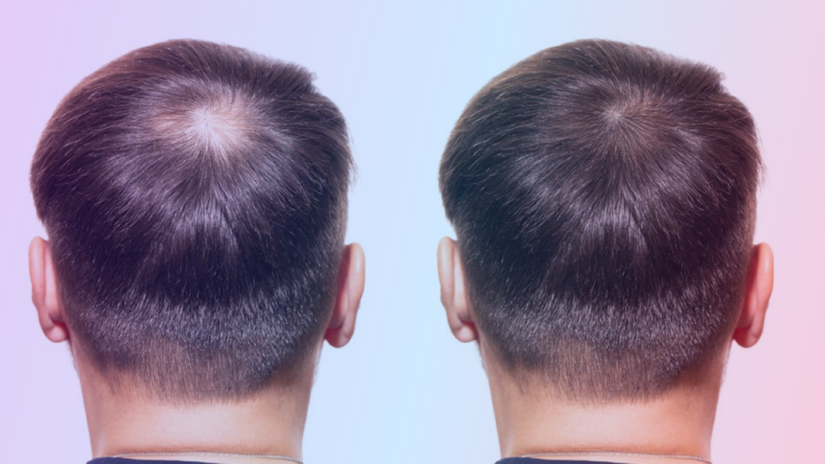 FUE Hair Transplant